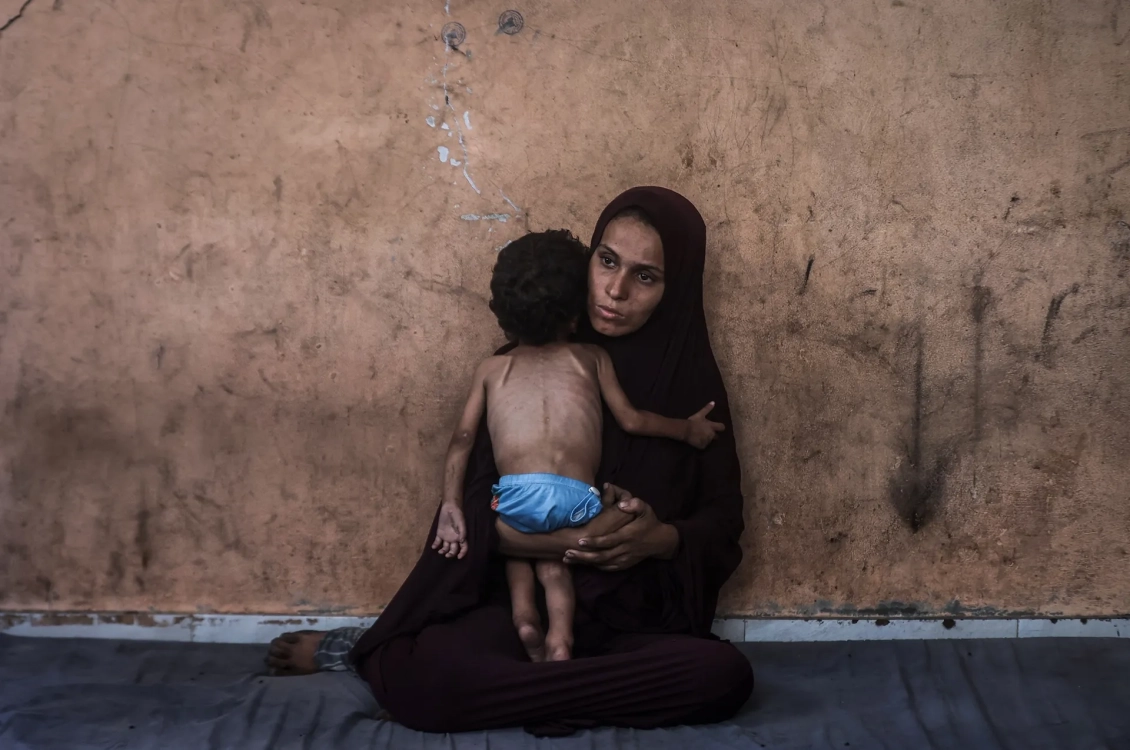A woman holds a severely malnourished child in Gaza.